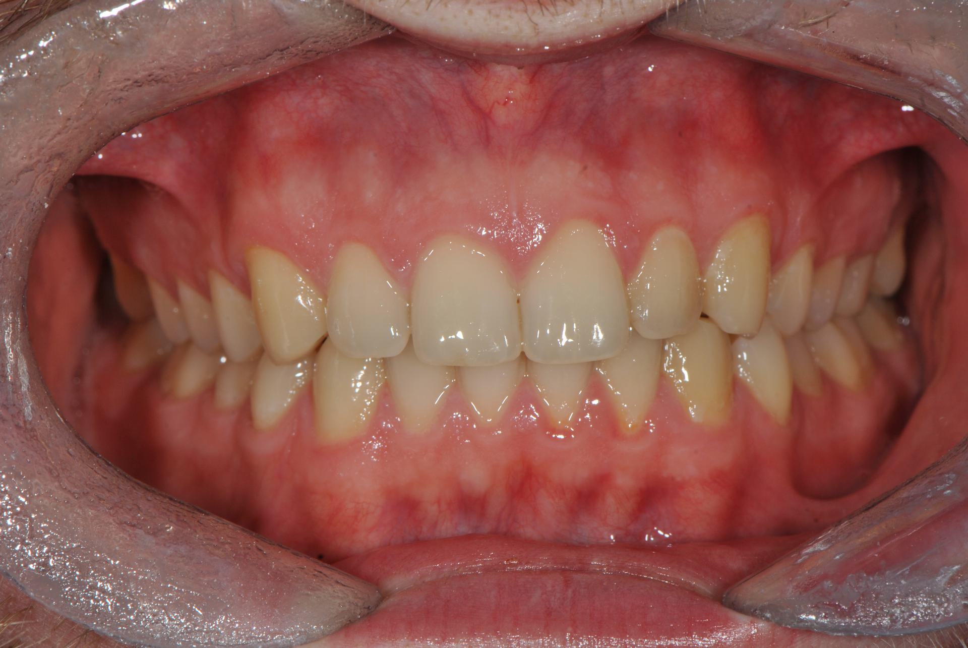 Нейтральная окклюзия. Диастема. Аномалии положения отдельных зубов. Мужчина, 26 лет