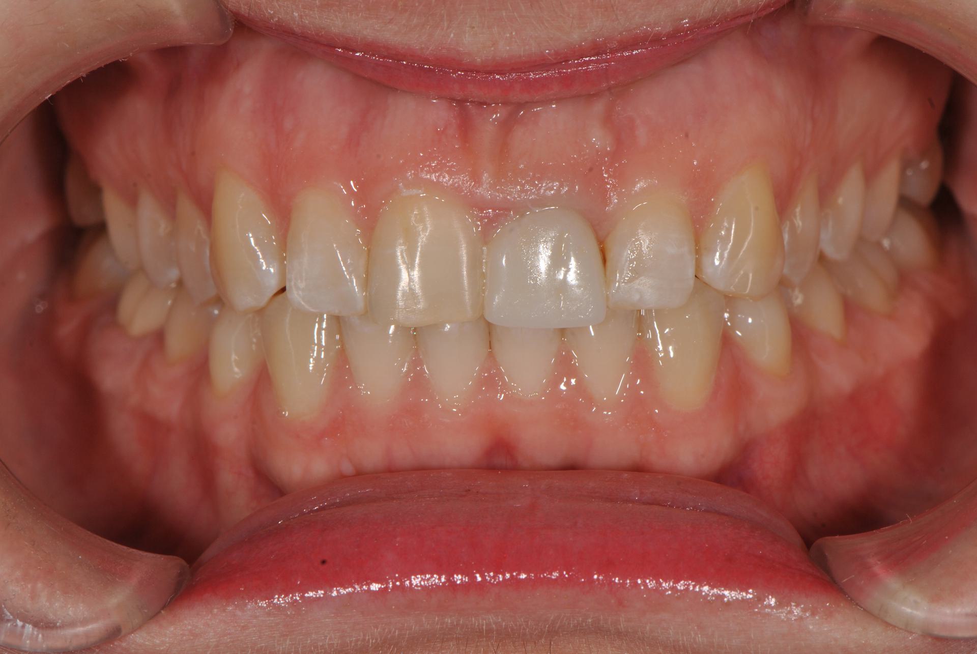 Нейтральная окклюзия. Скученное положение фронтальной группы зубов на нижней челюсти. Женщина, 25 лет