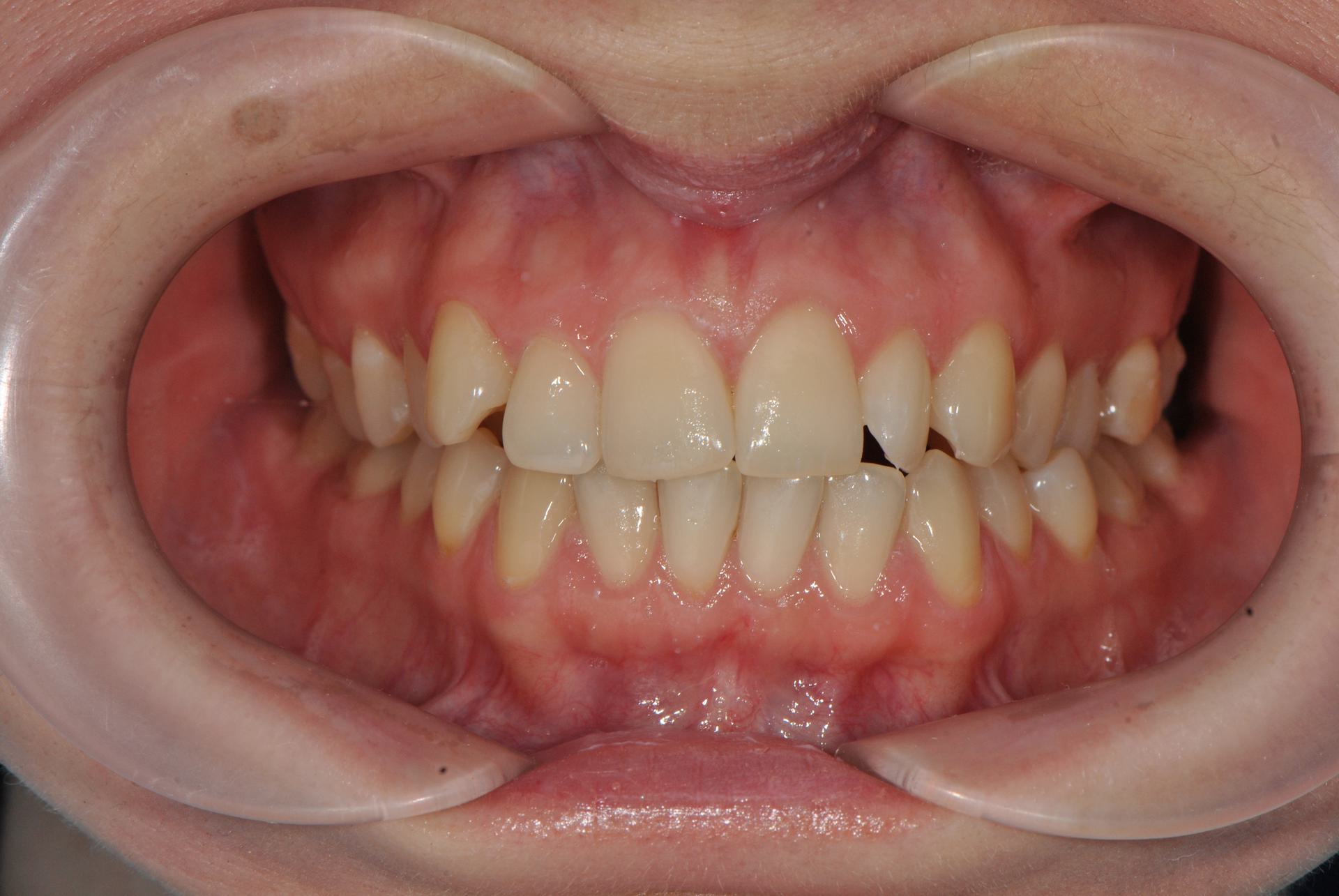 Нейтральная окклюзия. Cкученное положение фронтальной группы зубов на верхней и нижней челюстях. Женщина, 27 лет