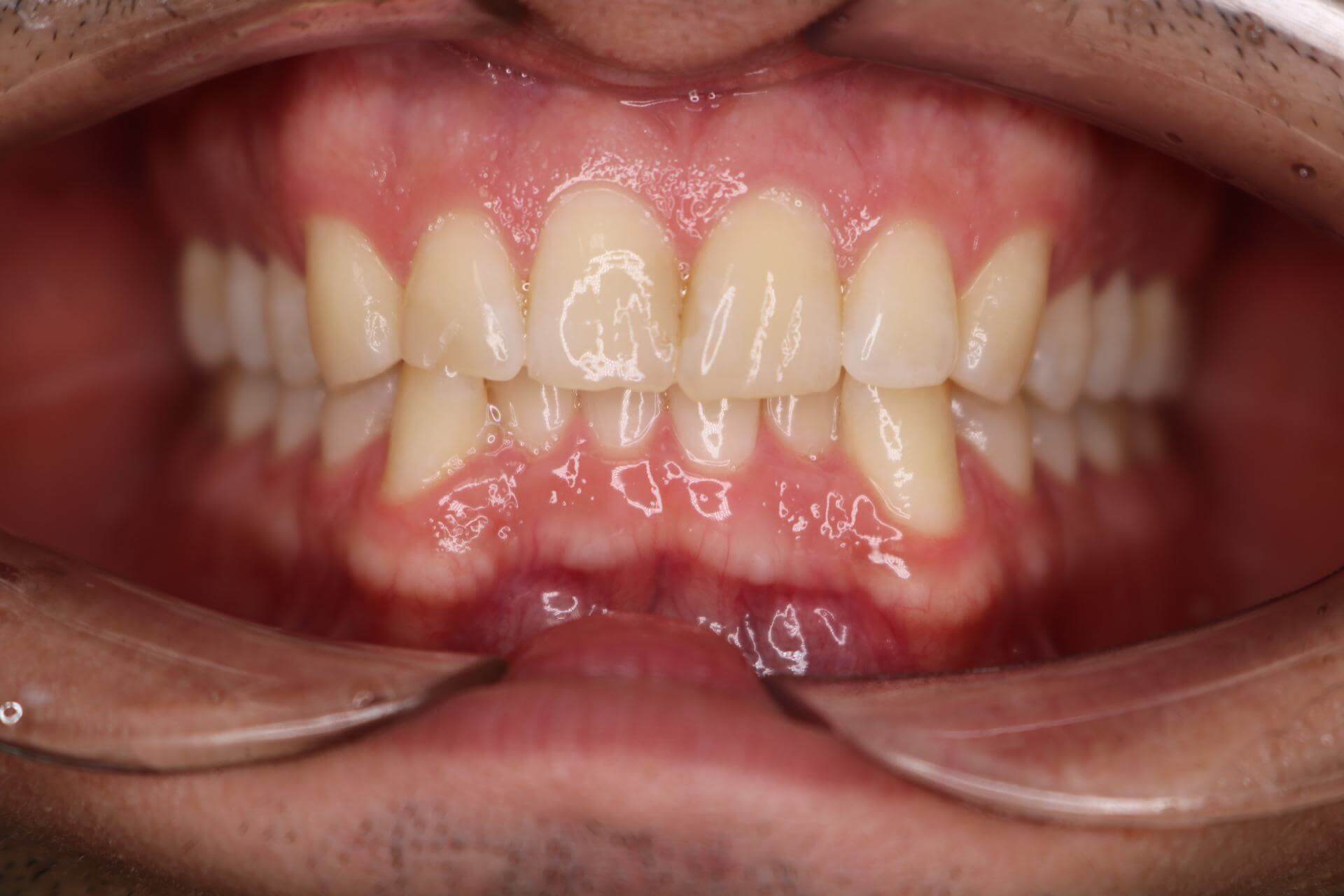 Сужение зубных рядов. Аномалия положения зубов. Скученность. Мужчина, 33 года