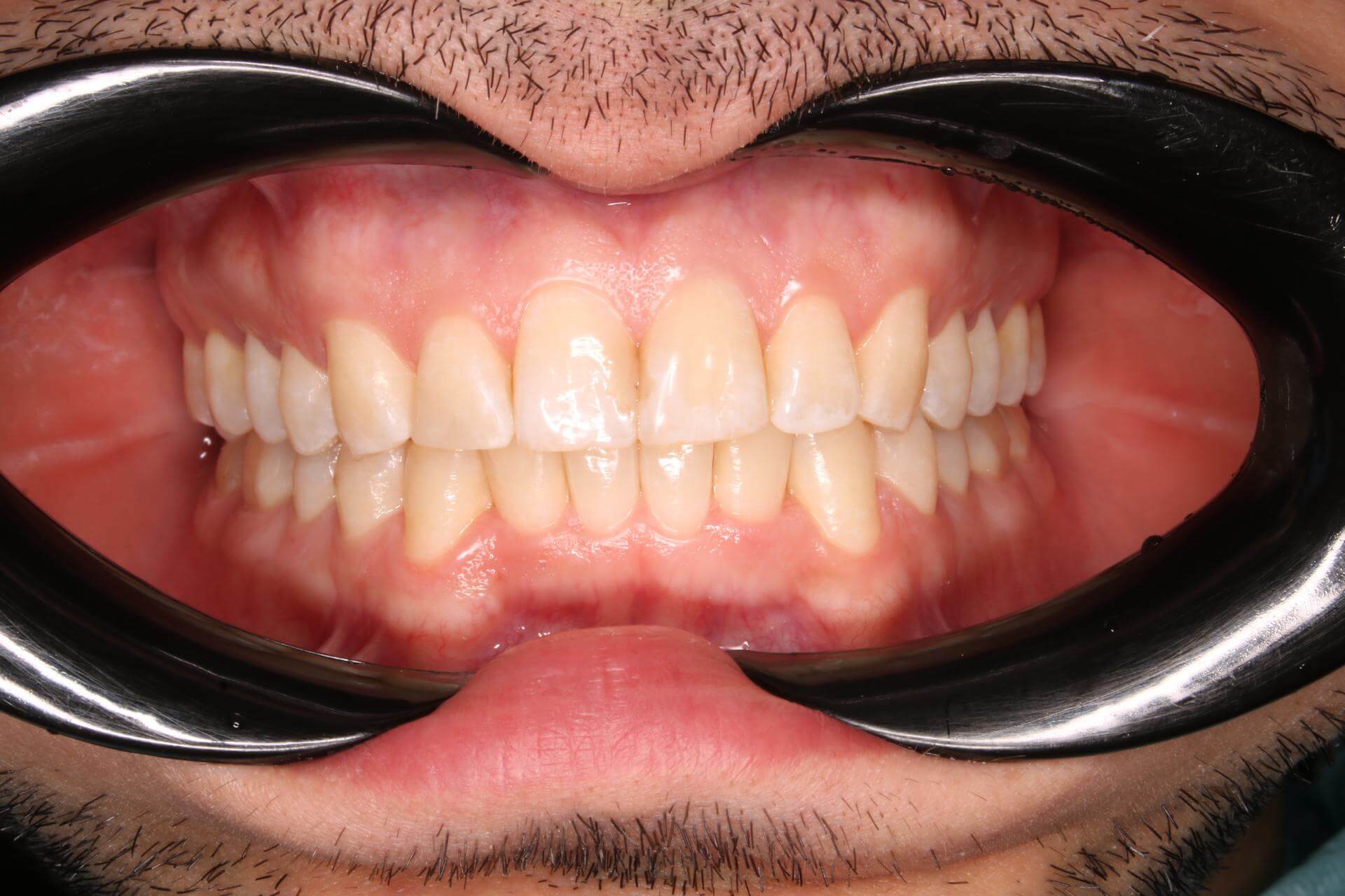 Сужение зубных рядов. Аномалия положения зубов. Скученность. Мужчина, 33 года