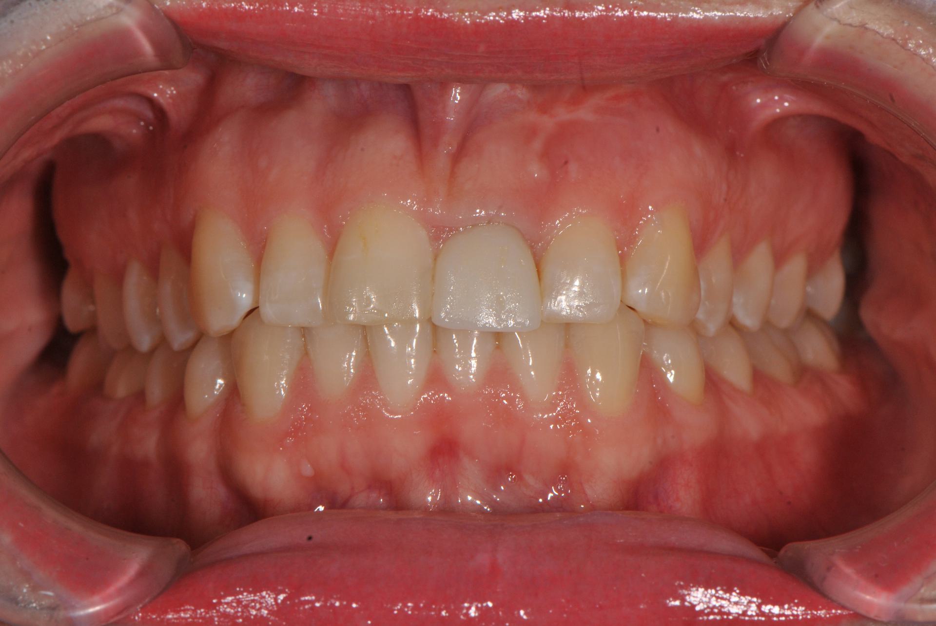 Нейтральная окклюзия. Скученное положение фронтальной группы зубов на нижней челюсти. Женщина, 25 лет