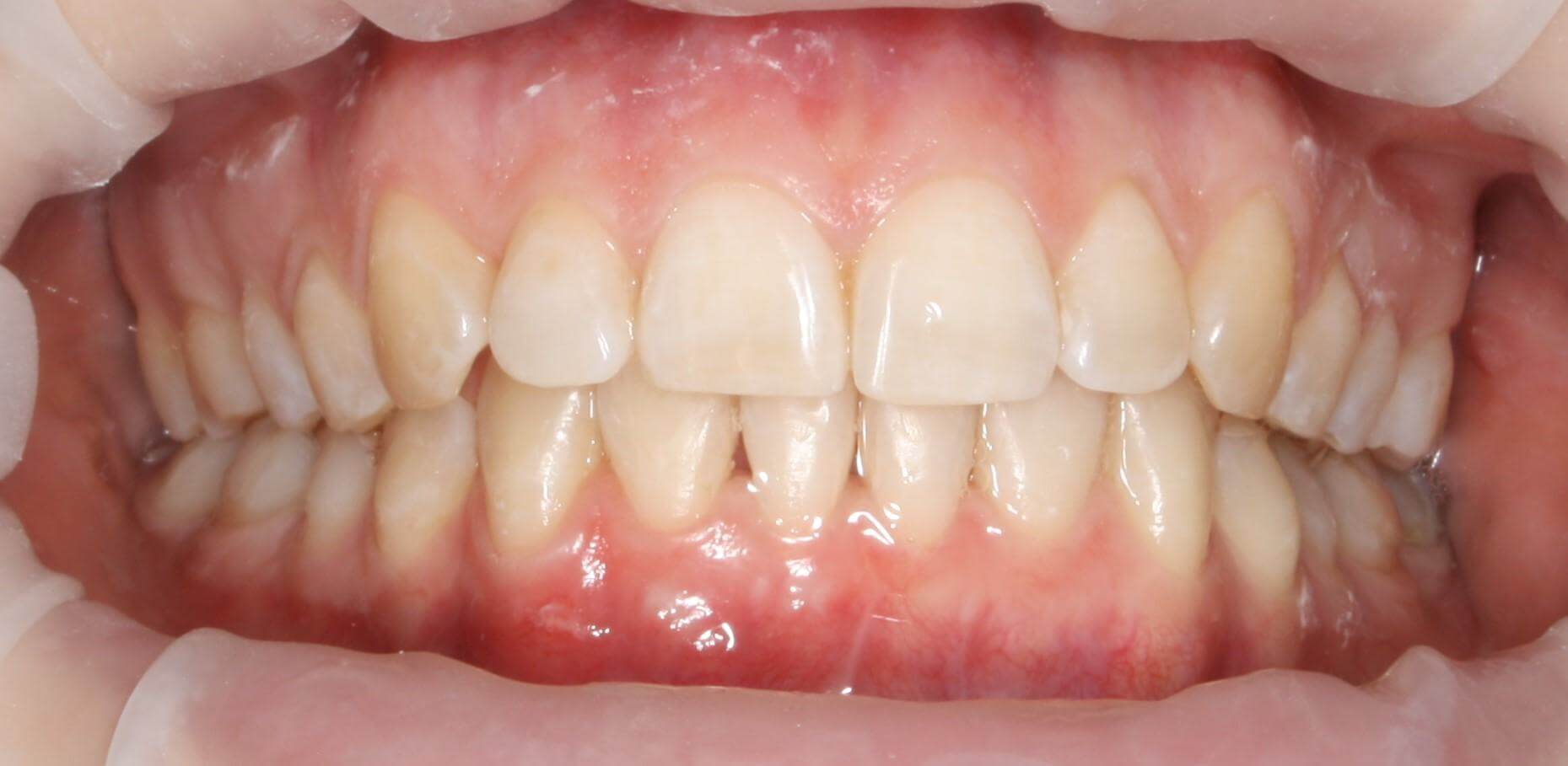 Скученность зубов, Глубокий прикус, Дистальная окклюзия слева. Женщина, 27 лет.