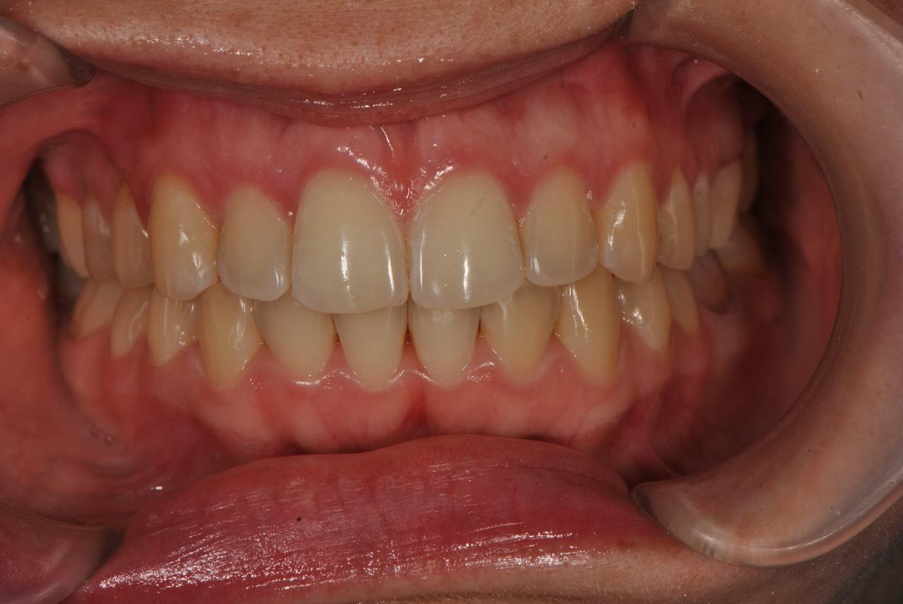 Нейтральная окклюзия. Скученность, аномалии положения отдельных зубов. Женщина, 25 лет.