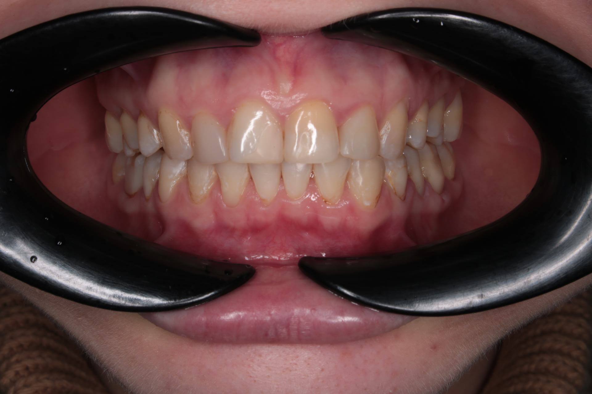 Скученность зубов на нижней челюсти. Женщина, 35 лет.