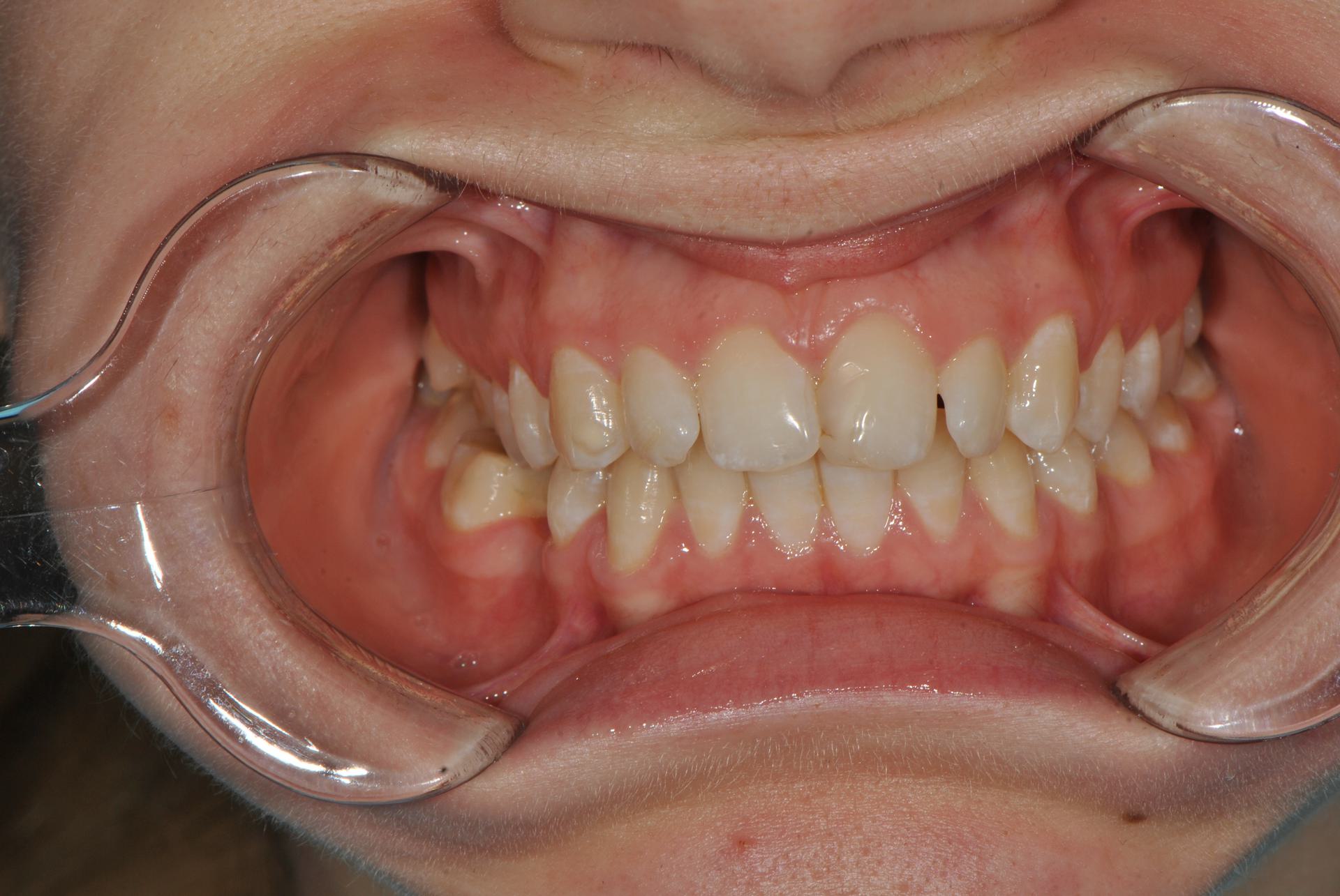 Нейтральная окклюзия. Скученность. Аномалии положения отдельных зубов. Женщина, 26 лет