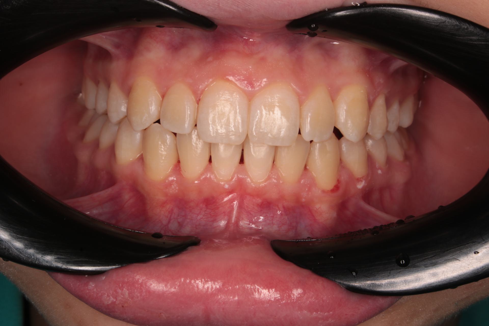Сужение зубных рядов. Аномалия положения зубов. Ретенция зуба 2.3. Девушка, 18 лет