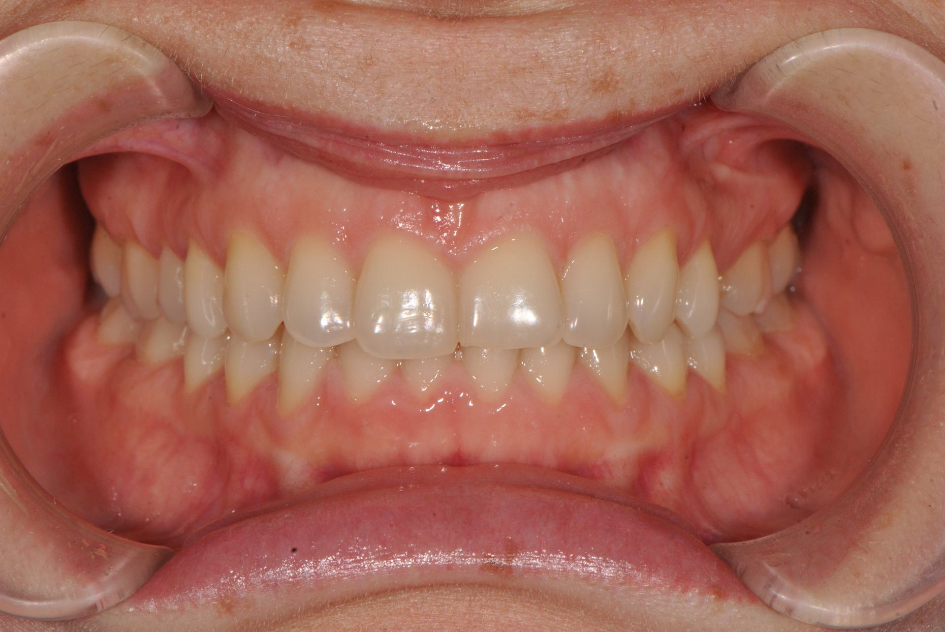 Нейтральная окклюзия. Аномалии положения отдельных зубов. Женщина, 27 лет