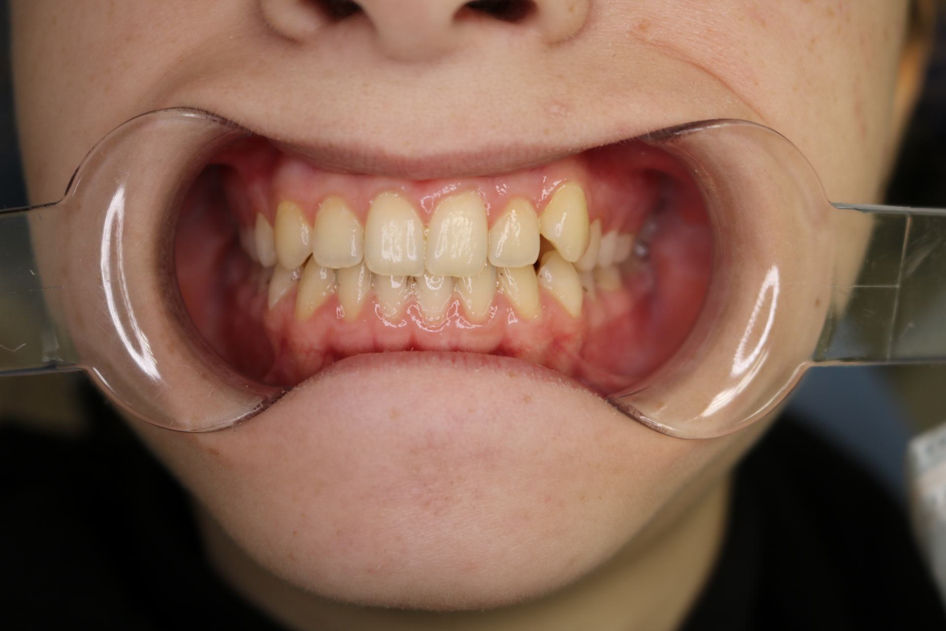 Сужение зубных рядов. Аномалия положения зубов. Девочка, 14 лет