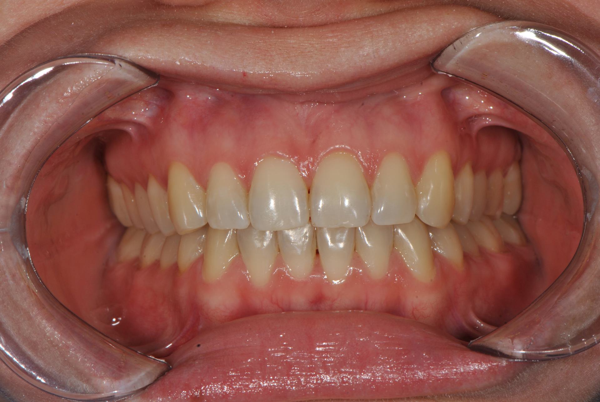Нейтральная окклюзия. Аномалии положения отдельных зубов. Женщина, 26 лет