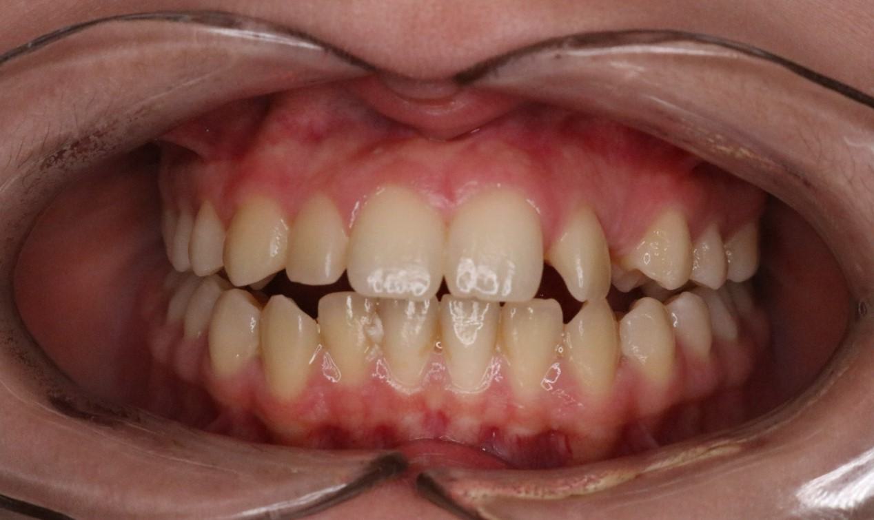 Сужение зубных рядов. Аномалия положения зубов. Ретенция зуба 2.3. Девушка, 18 лет