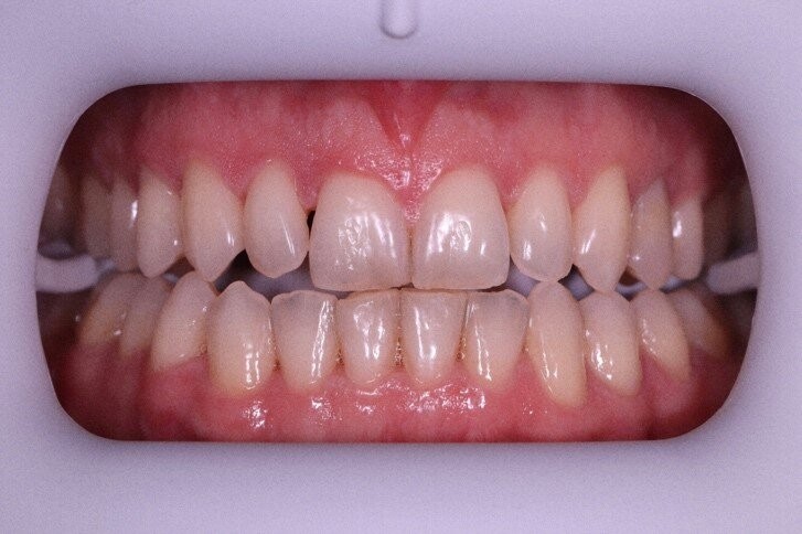 Рис 1. Исходный цвет до начала ортодонтического лечения