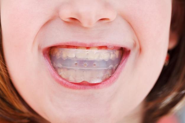 Трейнеры помогают позиционировать челюсти и частично перемещают зубы при небольшом искривлении