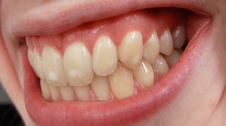 Белые пятна на зубах после элайнеров и брекетов: причины и профилактика.